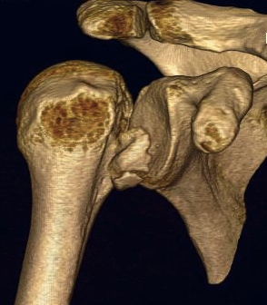 Posterior Shoulder Dislocation CT 2